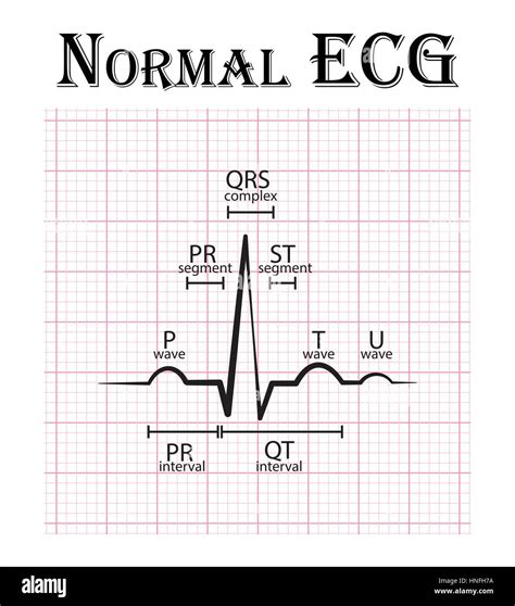 normal ecg images.